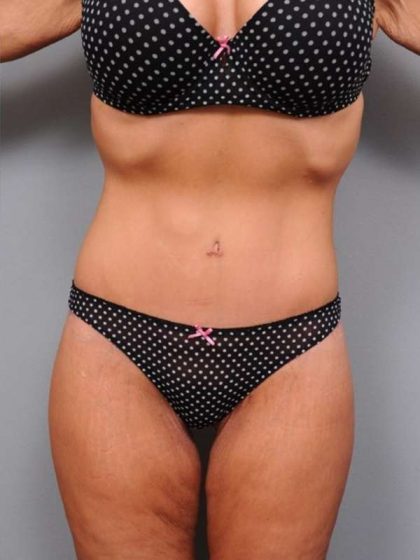 Lower Body Lift Before & After Patient #1010