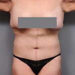Lower Body Lift Before & After Patient #1027