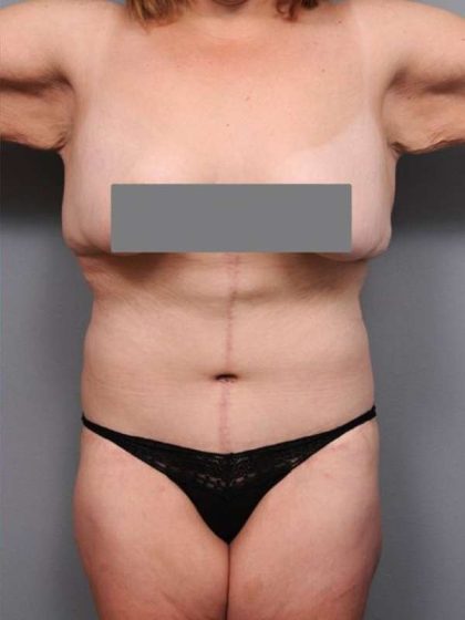 Lower Body Lift Before & After Patient #1027