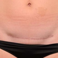 Scar Revision Before & After Patient #1041