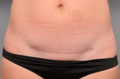 Scar Revision Before & After Patient #1041