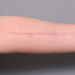 Scar Revision Before & After Patient #1044