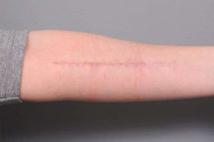 Scar Revision Before & After Patient #1044