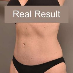 Tummy Tuck Before & After Patient #296