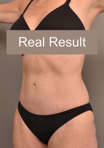 Tummy Tuck Before & After Patient #296