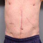 Scar Revision Before & After Patient #1047