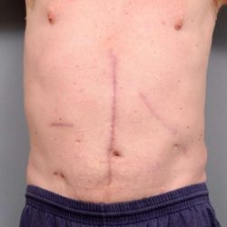 Scar Revision Before & After Patient #1047