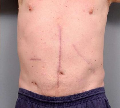 Scar Revision Before & After Patient #1047