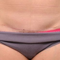 Scar Revision Before & After Patient #1050
