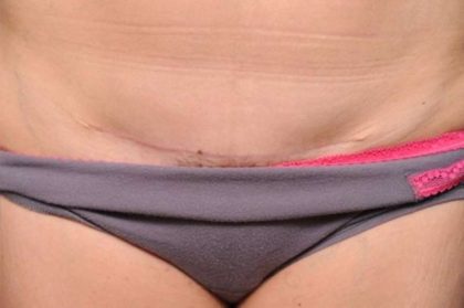 Scar Revision Before & After Patient #1050