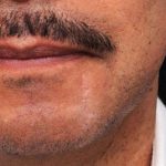 Scar Revision Before & After Patient #1053
