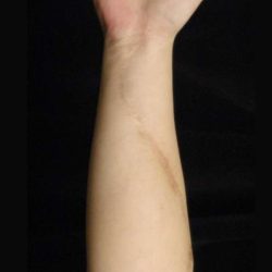 Scar Revision Before & After Patient #1056