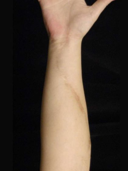 Scar Revision Before & After Patient #1056