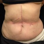 Scar Revision Before & After Patient #1059