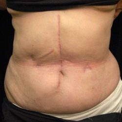 Scar Revision Before & After Patient #1059