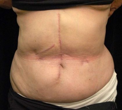 Scar Revision Before & After Patient #1059