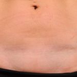 Scar Revision Before & After Patient #1071