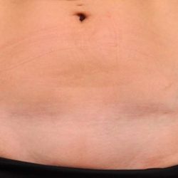 Scar Revision Before & After Patient #1071