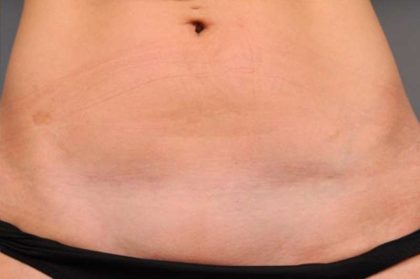 Scar Revision Before & After Patient #1071