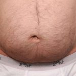 Belly Button Surgery Before & After Patient #1074