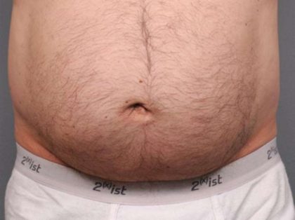 Belly Button Surgery Before & After Patient #1074