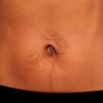 Belly Button Surgery Before & After Patient #1079