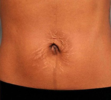 Belly Button Surgery Before & After Patient #1079