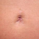 Belly Button Surgery Before & After Patient #1084