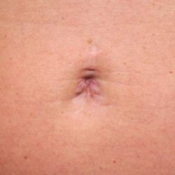 Belly Button Surgery Before & After Patient #1084