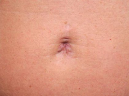 Belly Button Surgery Before & After Patient #1084
