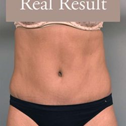 Tummy Tuck Before & After Patient #303