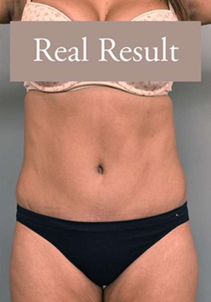Tummy Tuck Before & After Patient #303