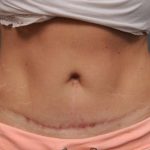 Belly Button Surgery Before & After Patient #1089