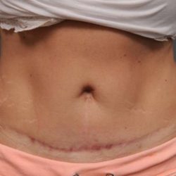 Belly Button Surgery Before & After Patient #1089