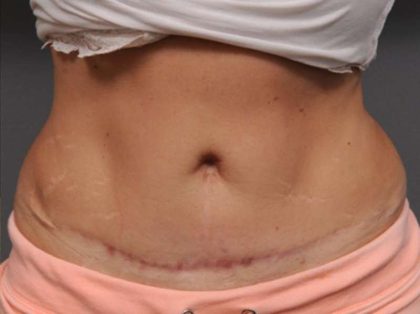 Belly Button Surgery Before & After Patient #1089