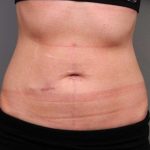 Belly Button Surgery Before & After Patient #1092