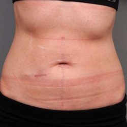 Belly Button Surgery Before & After Patient #1092