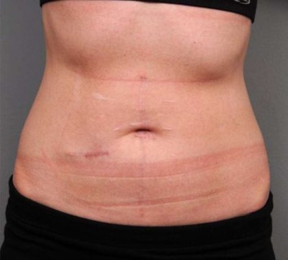 Belly Button Surgery Before & After Patient #1092