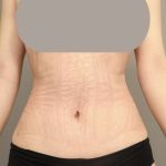 Scarless Rib Contouring (RibXcar) Before & After Patient #1097