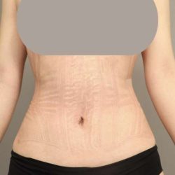Scarless Rib Contouring (RibXcar) Before & After Patient #1097