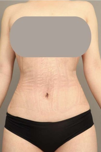 Scarless Rib Contouring (RibXcar) Before & After Patient #1097