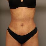 Scarless Rib Contouring (RibXcar) Before & After Patient #1103
