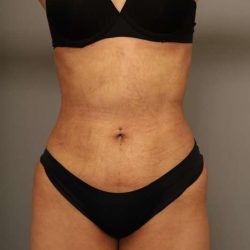 Scarless Rib Contouring (RibXcar) Before & After Patient #1103