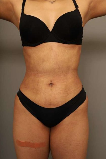 Scarless Rib Contouring (RibXcar) Before & After Patient #1103