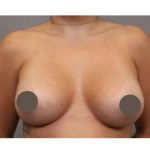 Under The Muscle Breast Augmentation Before & After Patient #1113