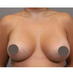 Under The Muscle Breast Augmentation Before & After Patient #1113