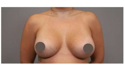 Under The Muscle Breast Augmentation Before & After Patient #1113