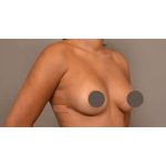 Under The Muscle Breast Augmentation Before & After Patient #1116