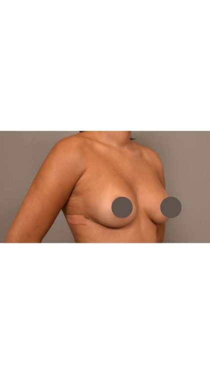 Under The Muscle Breast Augmentation Before & After Patient #1116
