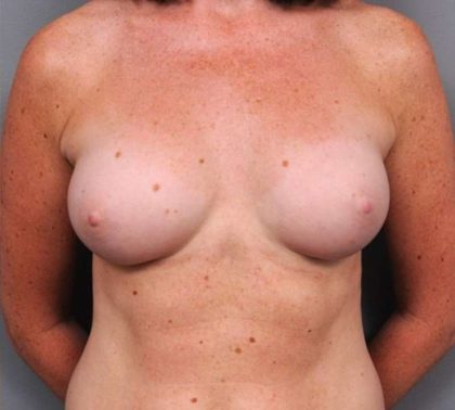 Under The Muscle Breast Augmentation Before & After Patient #1128